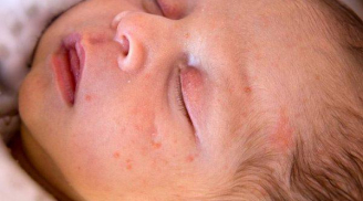 Bác sĩ mách mẹ những việc nên làm khi thấy mụn sữa ở trẻ sơ sinh