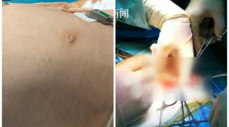 Bé 4 tuổi bụng phình to bất thường, đi khám bác sỹ kết luận điều khủng khiếp