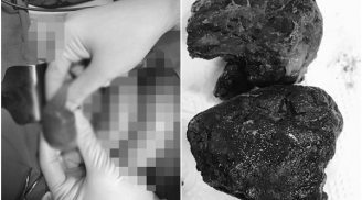 Chàng trai bị tắc ruột phải cấp cứu vì thói quen bỏ cơm, uống trà sữa triền miên