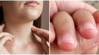 10 dấu hiệu cảnh báo Sh88bet đăng ký miễn phí có bệnh, thiếu chất trầm trọng: Đốm trắng trên móng tay, nhiệt miệng, rụng tóc...