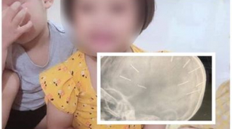 Vụ bé gái có dị vật ở đầu: Xác định nghi phạm chính là người tình của mẹ bé
