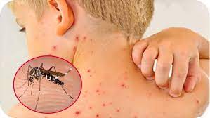 Trẻ sốt xuất huyết 3-7 ngày đầu là thời điểm dễ trở nặng, nhiều biến chứng: BS khuyên cha mẹ làm ngay 1 điều