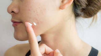 8 công thức làm đẹp với oxy già “rẻ như bèo” mà hiệu quả chẳng kém mỹ phẩm