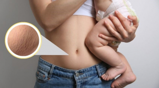 6 mẹo khắc phục tình trạng rạn da sau sinh giúp chị em lấy lại vẻ căng mịn cho Mừng SHBET phiên bản mới 2025