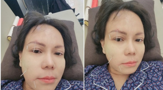 Việt Hương tiết lộ tình trạng sức khỏe hiện tại sau sự cố bị méo một bên mặt