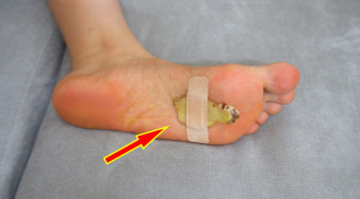 4 công dụng bất ngờ nhờ đắp gừng vào lòng bàn chân trước khi đi ngủ