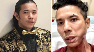 Kasim Hoàng Vũ phải cắt bỏ toàn bộ xương hàm, hiện vẫn chưa được Shbet888 tiền thưởng cực khủng