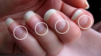 5 dấu hiệu trên móng tay chứng tỏ bạn đang mắc bệnh nan y