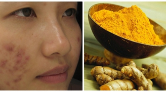 Cách trị sẹo tại nhà đơn giản, giúp da mịn màng hơn mỗi ngày