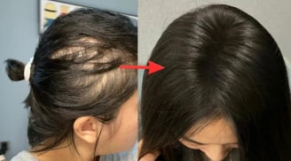Lời khuyên dành phụ nữ có tóc rụng nhiều, mọc chậm, tóc càng ngày càng mỏng