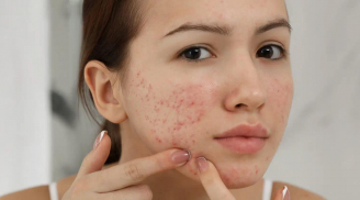 Cách làm mờ thâm mụn bằng kem đánh răng tại nhà