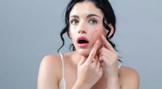 Chăm sóc da đúng cách sau nặn mụn giúp giảm nguy cơ thâm sẹo và phục hồi da nhanh hơn