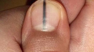 5 dấu hiệu trên móng tay cảnh báo bệnh nan y: Có 1 trong 5 dấu hiệu cũng nên đi khám gấp