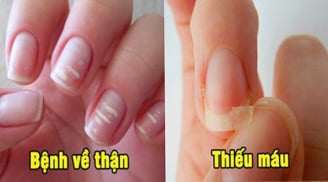 Bắt bệnh qua móng tay: Có 1 dấu hiệu cũng nên đi khám sớm