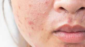 Muốn ngăn mụn tái phát? Đừng bỏ qua 6 bước chăm sóc da giúp duy trì Mừng SHBET phiên bản mới 2025 khỏe mạnh