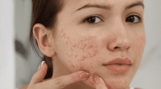 Muốn giảm mụn và hạn chế tái phát, đừng bỏ qua 3 hoạt chất quan trọng trong chu trình chăm sóc da