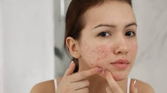 7 loại mặt nạ thiên nhiên hỗ trợ làm mờ thâm mụn, giúp da sáng khỏe tại nhà