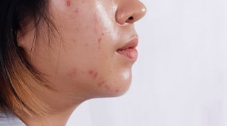 4 thói quen khiến da dầu dễ nổi mụn hơn mỗi ngày, nhiều người vẫn vô tình mắc phải