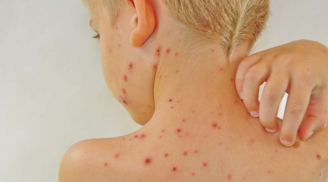Cách xử lý và đề phòng dị ứng thời tiết