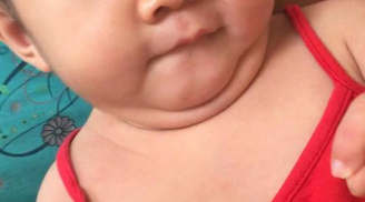 Hình ảnh mới của bé gái Lào Cai 14 tháng tuổi nặng 3,5kg sau hơn 3 tháng được mẹ nuôi chăm sóc