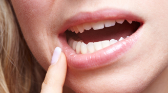 Dấu hiệu không ngờ cảnh báo bạn đang mắc ung thư miệng, cần tới bệnh viện ngay