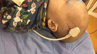 Thương tâm: Bé trai 2 tuổi ngã từ giường xuống đất bị phích cắm 3 chân xiên não
