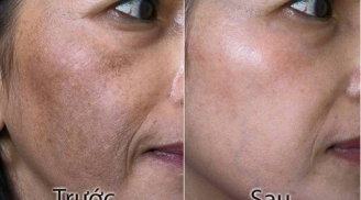 Sạch nám trong 1 tuần chỉ bằng cách dùng đá khoai tây