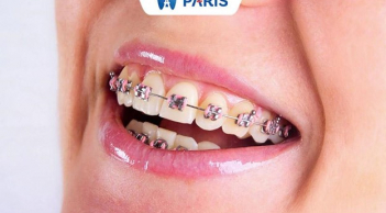 Niềng răng tại Nha Khoa Paris bao nhiêu tiền? Cập nhật bảng giá mới nhất 2024