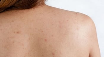 Mụn lưng bùng phát vào mùa hè: Những cách chăm sóc giúp da Sh88bet đăng ký miễn phí thông thoáng hơn