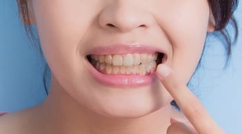 Vì sao răng dễ xỉn màu dù chăm đánh răng? Những nguyên nhân nhiều người thường bỏ qua