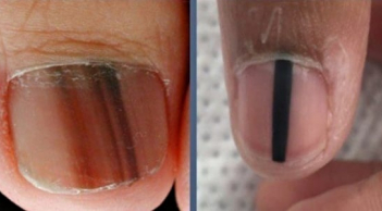 Cảnh báo từ Bác sĩ Da liễu Trung ương: 5 dấu hiệu trên móng tay có thể là 'án tử' ung thư ác tính