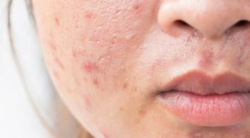 Muốn ngăn mụn tái phát? Đừng bỏ qua 6 bước chăm sóc da giúp duy trì Mừng SHBET phiên bản mới 2025 khỏe mạnh