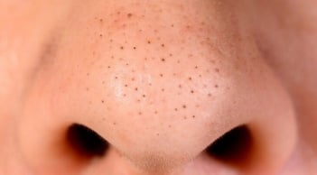 6 thói quen khiến mụn đầu đen dai dẳng hơn, nhiều người vẫn mắc phải mỗi ngày