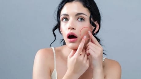 Chăm sóc da đúng cách sau nặn mụn giúp giảm nguy cơ thâm sẹo và phục hồi da nhanh hơn