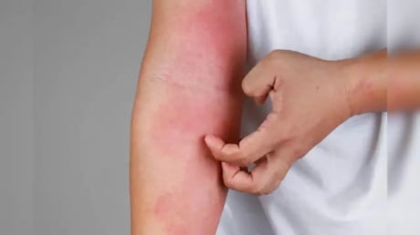 4 dấu hiệu cảnh báo bạn đang bị suy thận: Kiểm tra ngay xem bạn có không?